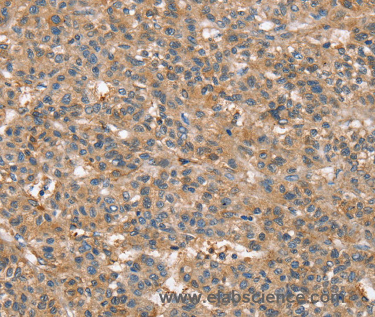 Immunohistochemistry of paraffin-embedded Human liver cancer using SSX2IP Polyclonal Antibody at dilution of 1:45