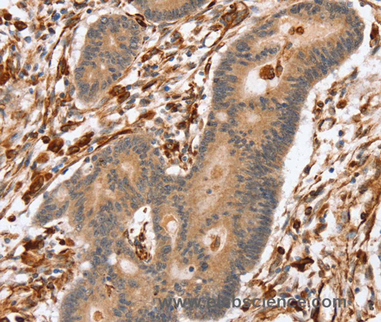 Immunohistochemistry of paraffin-embedded Human colon cancer using SSX2IP Polyclonal Antibody at dilution of 1:45