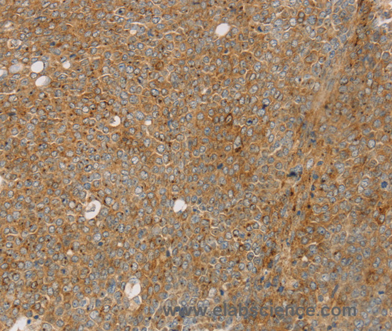 Immunohistochemistry of paraffin-embedded Human ovarian cancer using STX16 Polyclonal Antibody at dilution of 1:30