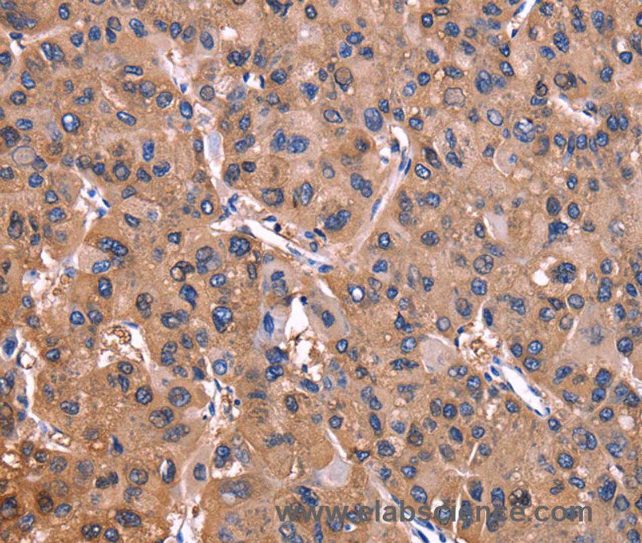 Immunohistochemistry of paraffin-embedded Human liver cancer tissue using ADM2 Polyclonal Antibody at dilution 1:40