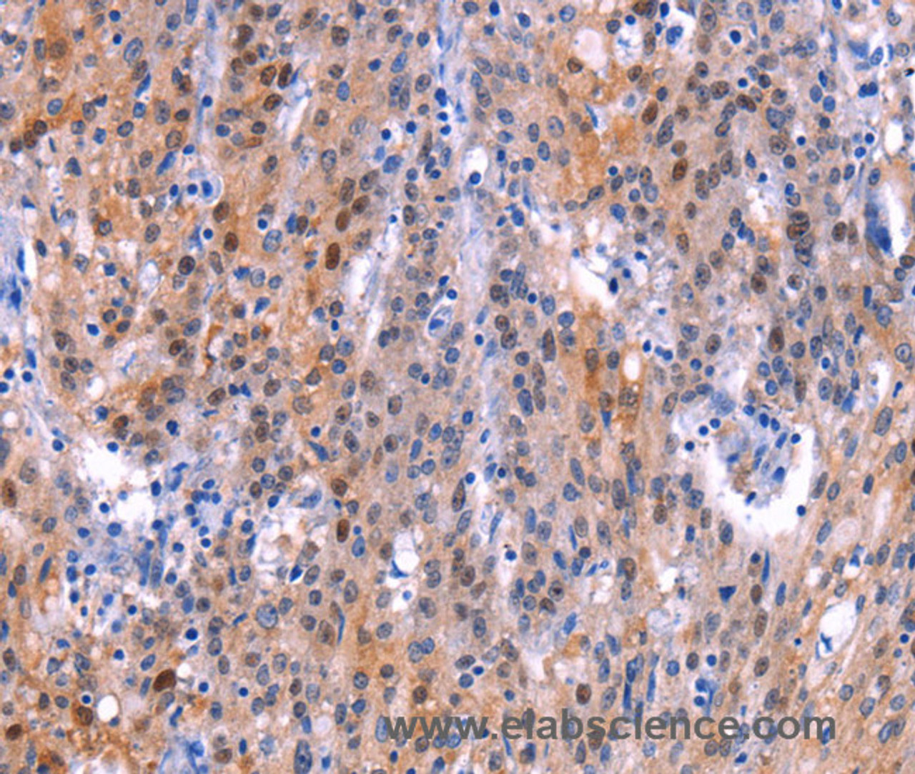 Immunohistochemistry of paraffin-embedded Human gastric cancer tissue using ADM2 Polyclonal Antibody at dilution 1:40
