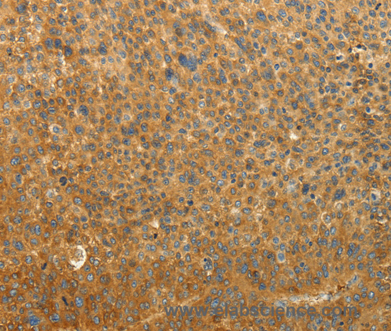 Immunohistochemistry of paraffin-embedded Human liver cancer tissue using RAB35 Polyclonal Antibody at dilution 1:50