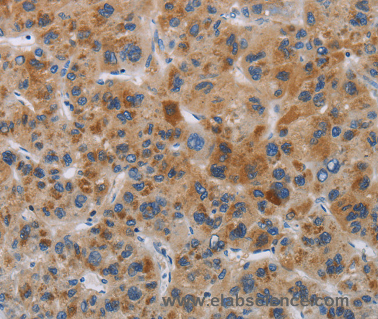 Immunohistochemistry of paraffin-embedded Human liver cancer tissue using IAPP Polyclonal Antibody at dilution 1:40
