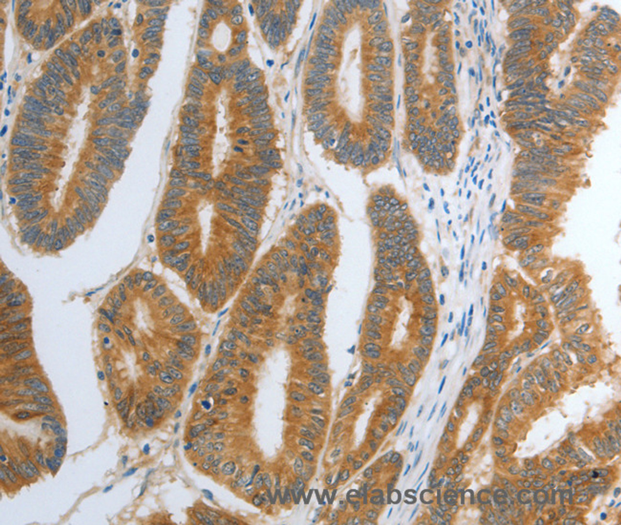 Immunohistochemistry of paraffin-embedded Human colon cancer tissue using RHEB Polyclonal Antibody at dilution 1:30