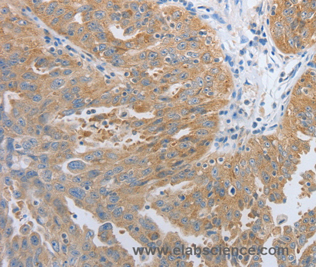 Immunohistochemistry of paraffin-embedded Human ovarian cancer tissue using RHEB Polyclonal Antibody at dilution 1:30
