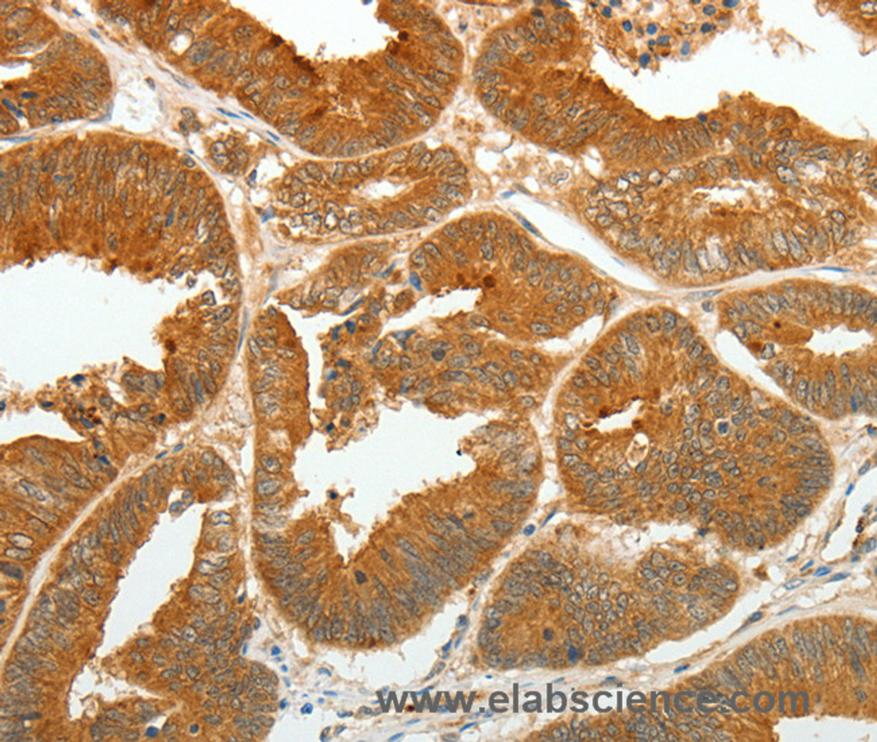 Immunohistochemistry of paraffin-embedded Human colon cancer tissue using ASCL1 Polyclonal Antibody at dilution 1:30