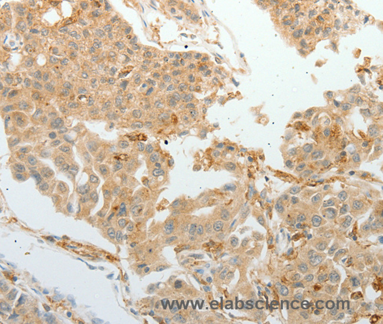 Immunohistochemistry of paraffin-embedded Human lung cancer tissue using ASCL1 Polyclonal Antibody at dilution 1:30