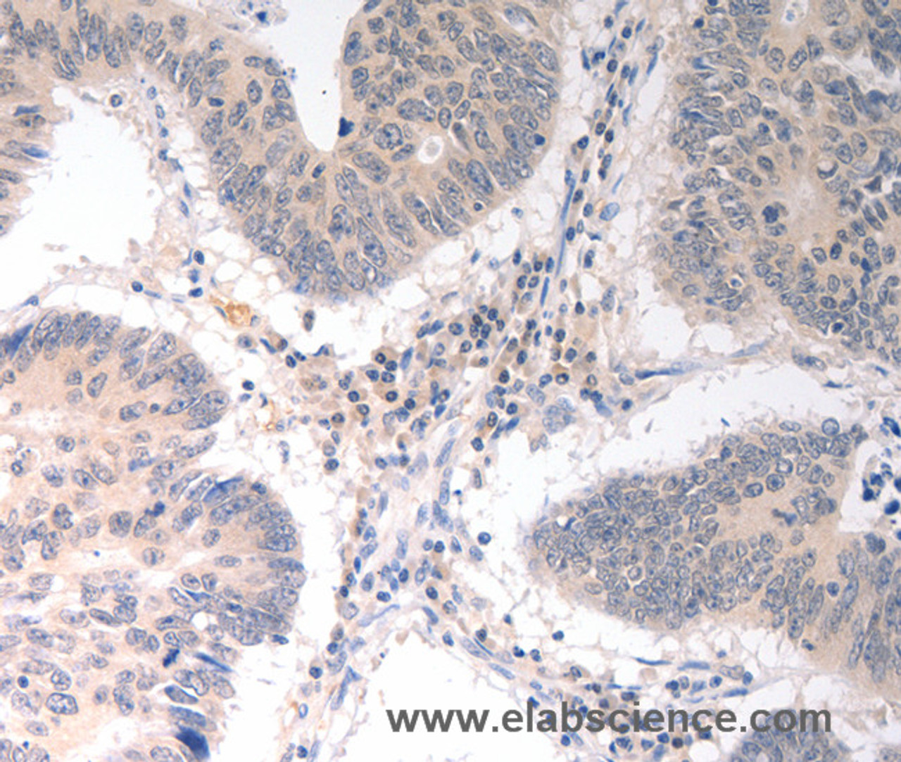 Immunohistochemistry of paraffin-embedded Human colon cancer tissue using CD275 Polyclonal Antibody at dilution 1:30