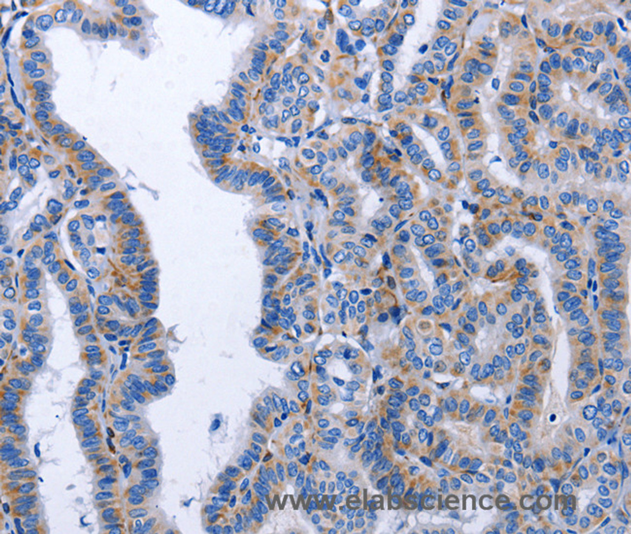 Immunohistochemistry of paraffin-embedded Human thyroid cancer tissue using BDNF Polyclonal Antibody at dilution 1:40