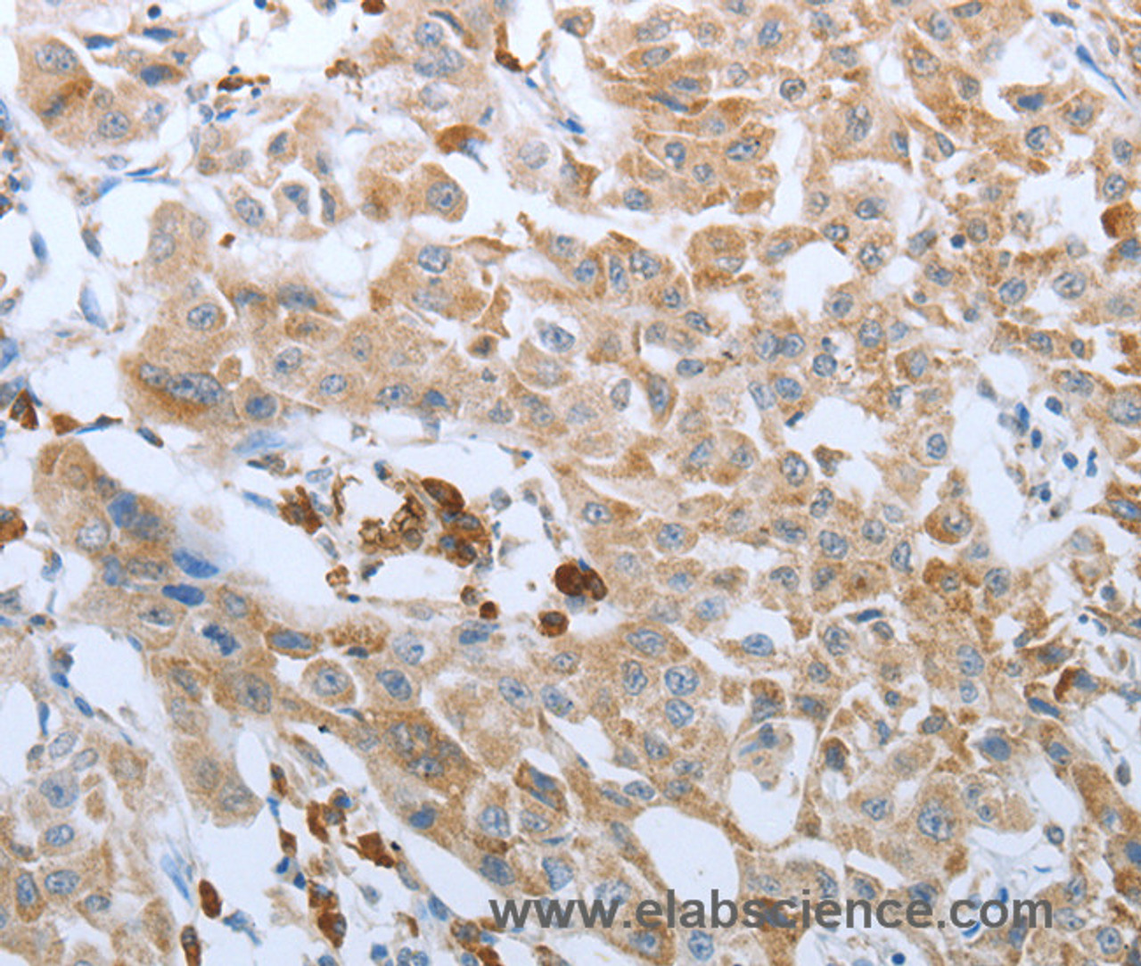 Immunohistochemistry of paraffin-embedded Human lung cancer tissue using FGF1 Polyclonal Antibody at dilution 1:50