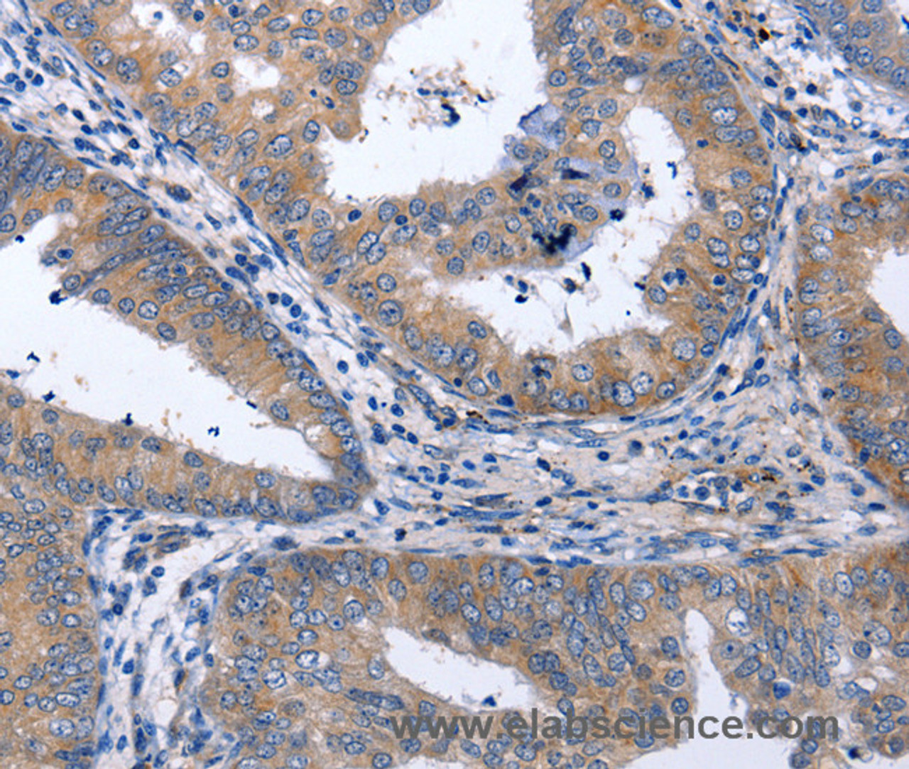 Immunohistochemistry of paraffin-embedded Human cervical cancer tissue using NPPB Polyclonal Antibody at dilution 1:40