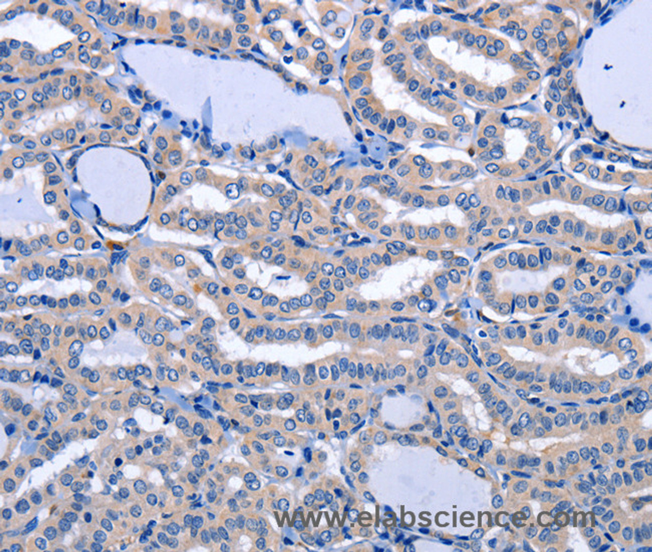 Immunohistochemistry of paraffin-embedded Human thyroid cancer tissue using NPPB Polyclonal Antibody at dilution 1:40