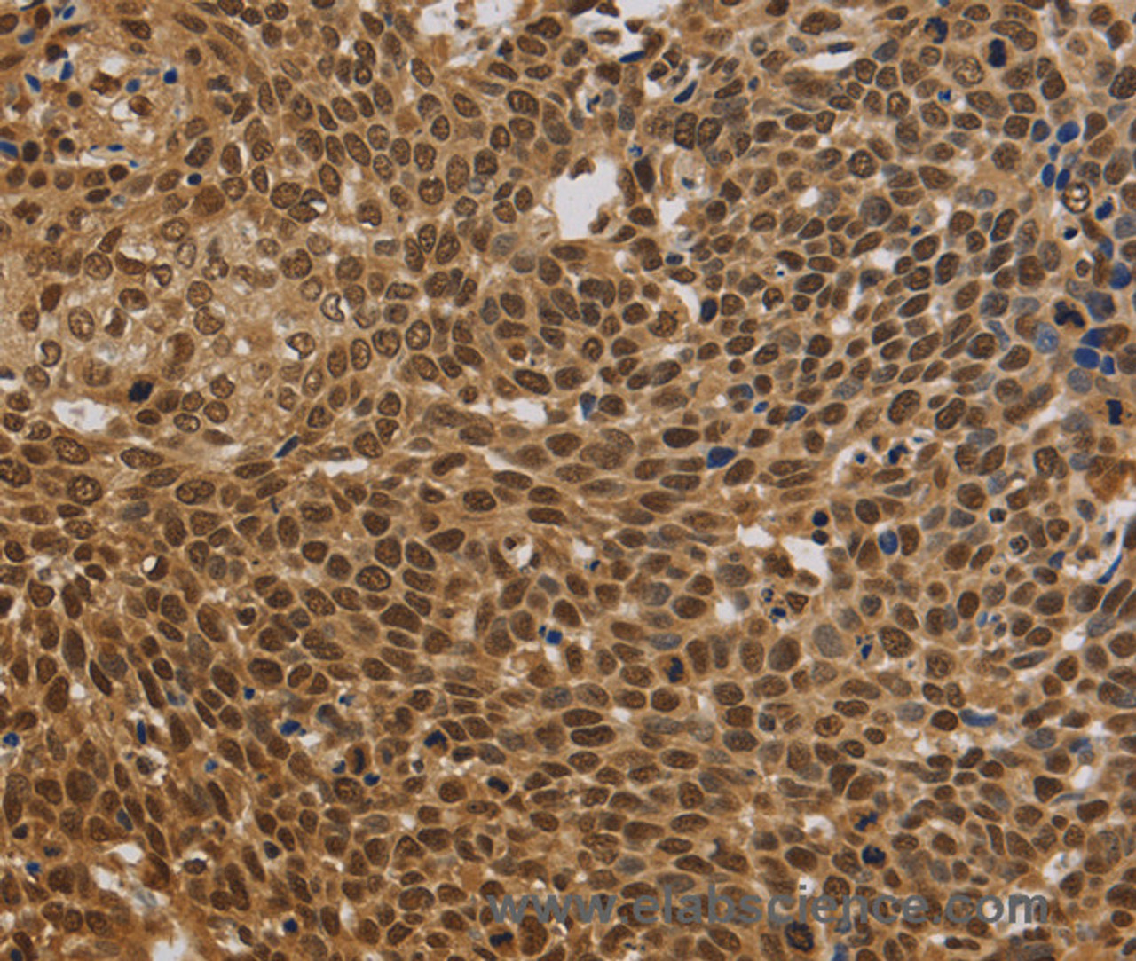 Immunohistochemistry of paraffin-embedded Human cervical cancer using BRAF Polyclonal Antibody at dilution of 1:30