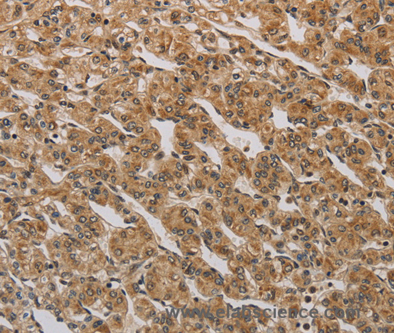 Immunohistochemistry of paraffin-embedded Human prostate cancer using BRAF Polyclonal Antibody at dilution of 1:30
