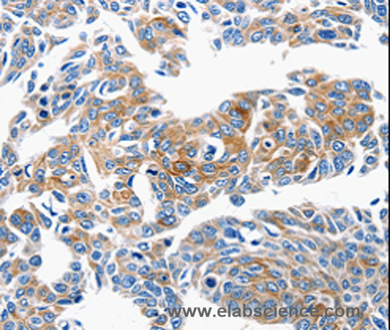 Immunohistochemistry of paraffin-embedded Human lung cancer tissue using CCL6 Polyclonal Antibody at dilution 1:50