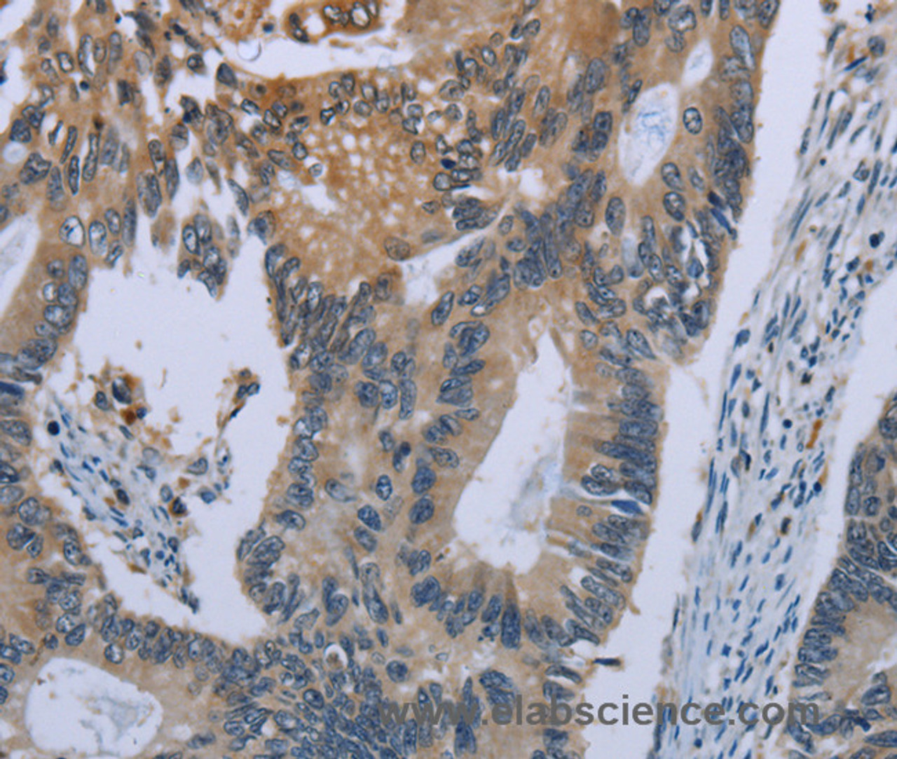 Immunohistochemistry of paraffin-embedded Human colon cancer using CEBPD Polyclonal Antibody at dilution of 1:40