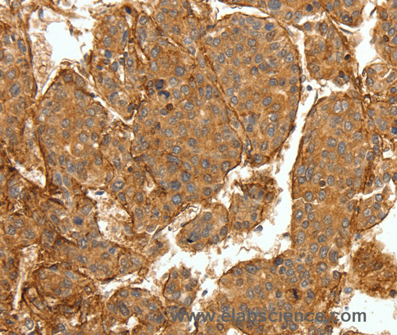 Immunohistochemistry of paraffin-embedded Human lung cancer tissue using COL4A1 Polyclonal Antibody at dilution 1:30