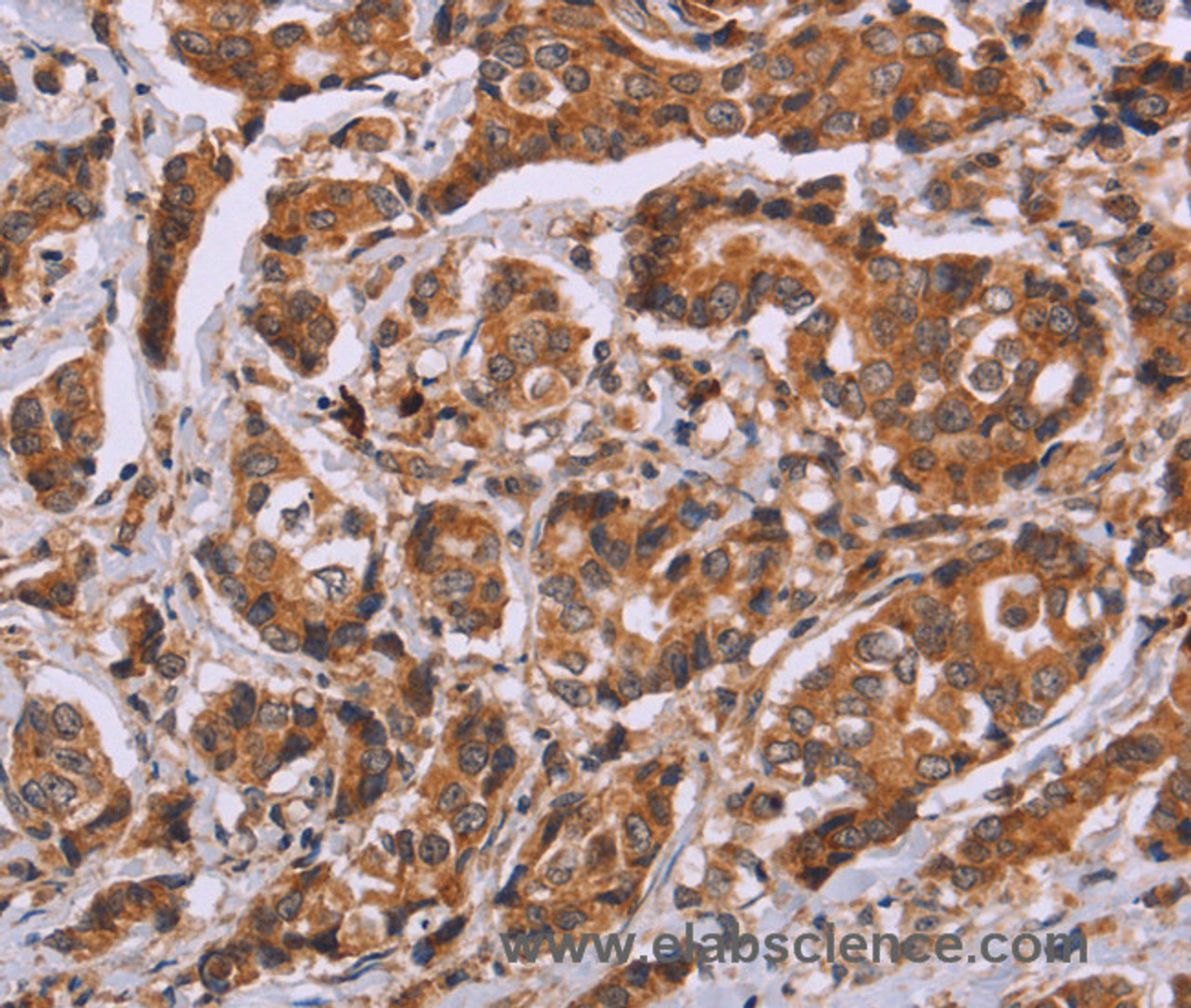 Immunohistochemistry of paraffin-embedded Human breast cancer tissue using CALCA Polyclonal Antibody at dilution 1:40