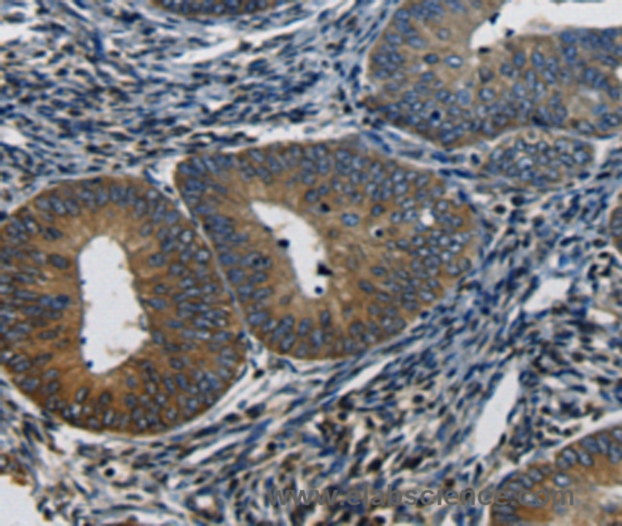 Immunohistochemistry of paraffin-embedded Human cervical cancer using CTGF Polyclonal Antibody at dilution of 1:50