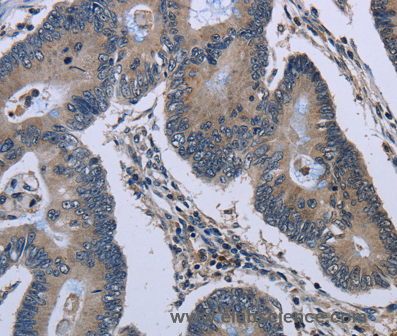 Immunohistochemistry of paraffin-embedded Human colon cancer tissue using Connexin 47 Polyclonal Antibody at dilution 1:40