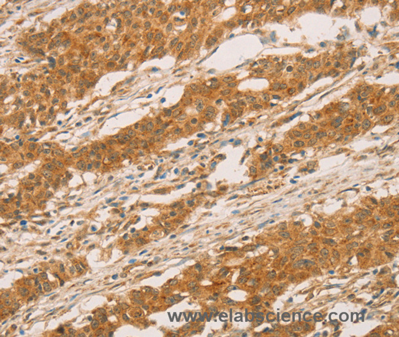 Immunohistochemistry of paraffin-embedded Human gastric cancer tissue using SLC6A3 Polyclonal Antibody at dilution 1:50