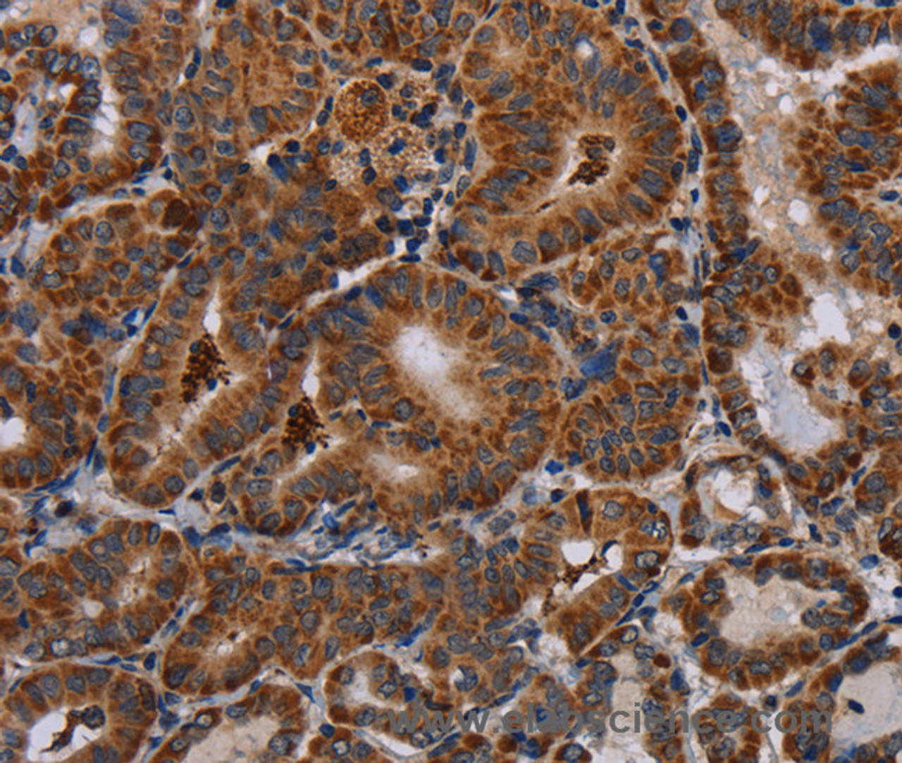 Immunohistochemistry of paraffin-embedded Human thyroid cancer tissue using DISC1 Polyclonal Antibody at dilution 1:30