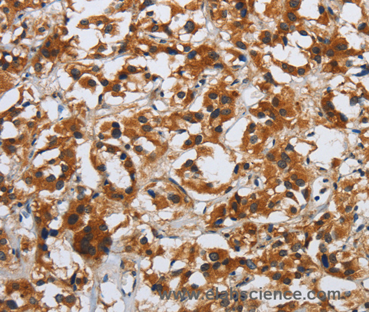 Immunohistochemistry of paraffin-embedded Human thyroid cancer tissue using DSP Polyclonal Antibody at dilution 1:40