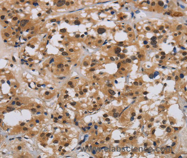 Immunohistochemistry of paraffin-embedded Human thyroid cancer tissue using E2F4 Polyclonal Antibody at dilution 1:40