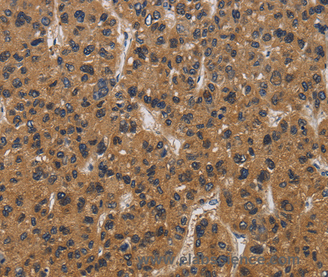Immunohistochemistry of paraffin-embedded Human liver cancer tissue using E2F4 Polyclonal Antibody at dilution 1:40