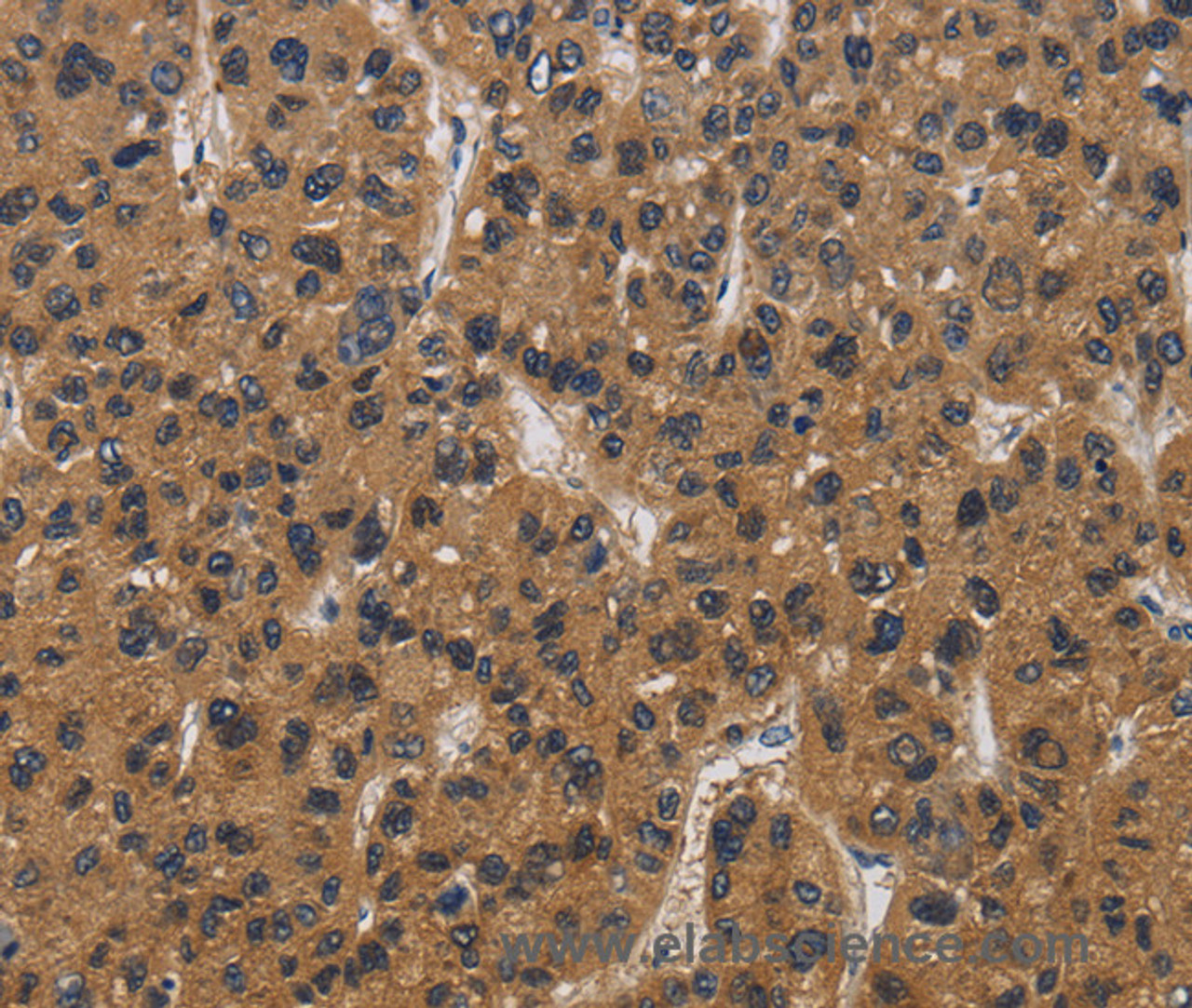Immunohistochemistry of paraffin-embedded Human liver cancer tissue using E2F4 Polyclonal Antibody at dilution 1:40