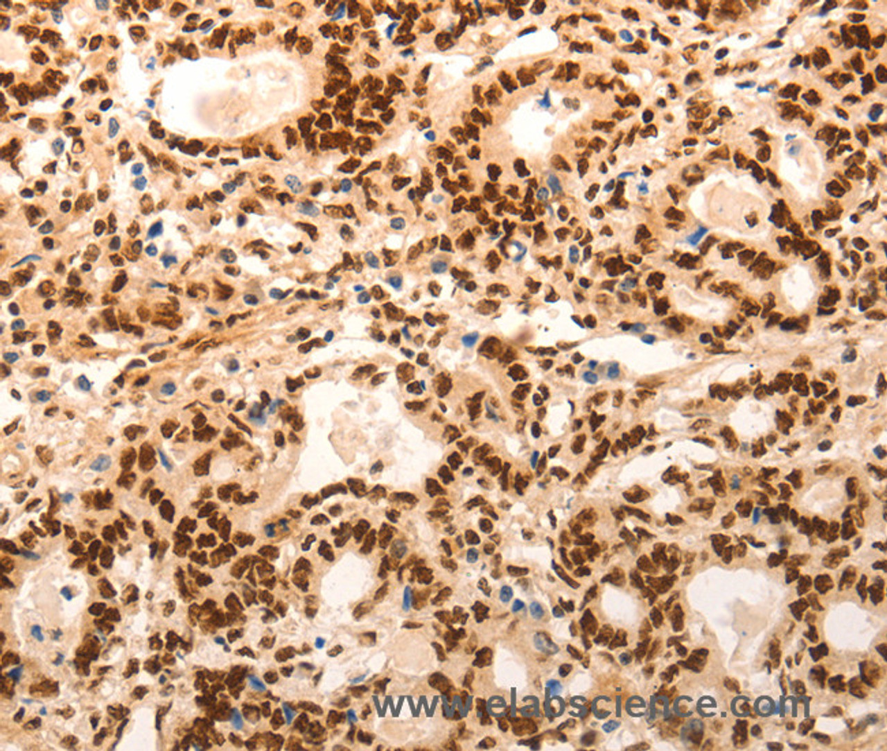Immunohistochemistry of paraffin-embedded Human gasrtic cancer tissue using E2F7 Polyclonal Antibody at dilution 1:60