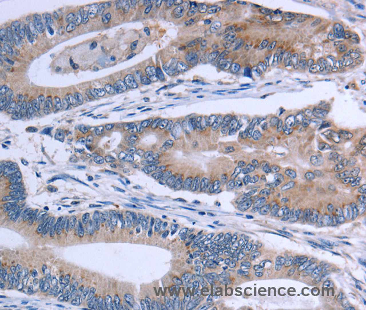 Immunohistochemistry of paraffin-embedded Human colon cancer using SLC1A6 Polyclonal Antibody at dilution of 1:40