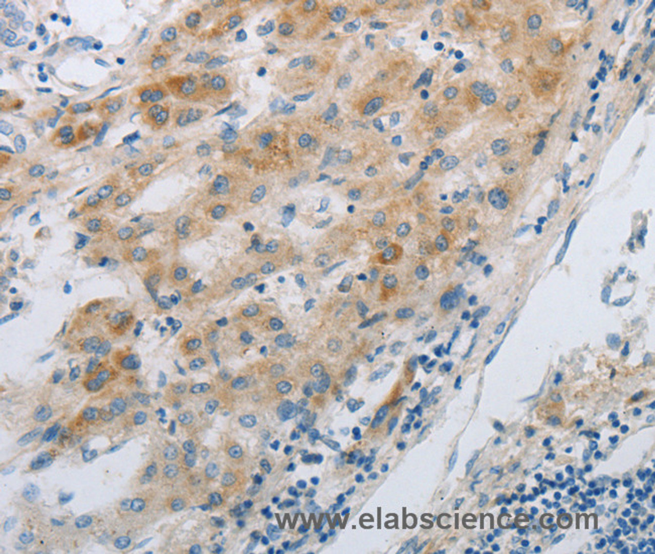 Immunohistochemistry of paraffin-embedded Human liver cancer using GJB6 Polyclonal Antibody at dilution of 1:30