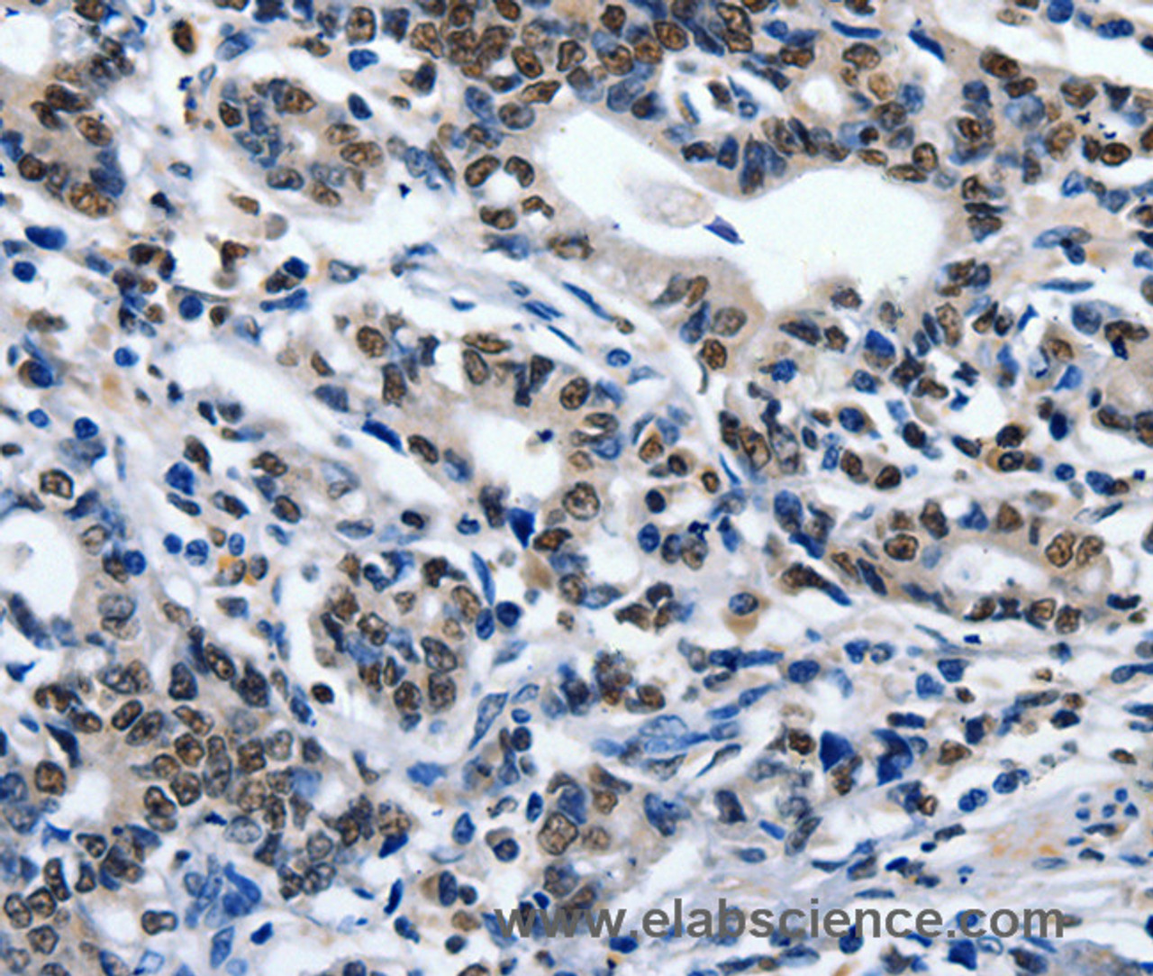 Immunohistochemistry of paraffin-embedded Human gasrtic cancer tissue using CD203c Polyclonal Antibody at dilution 1:80