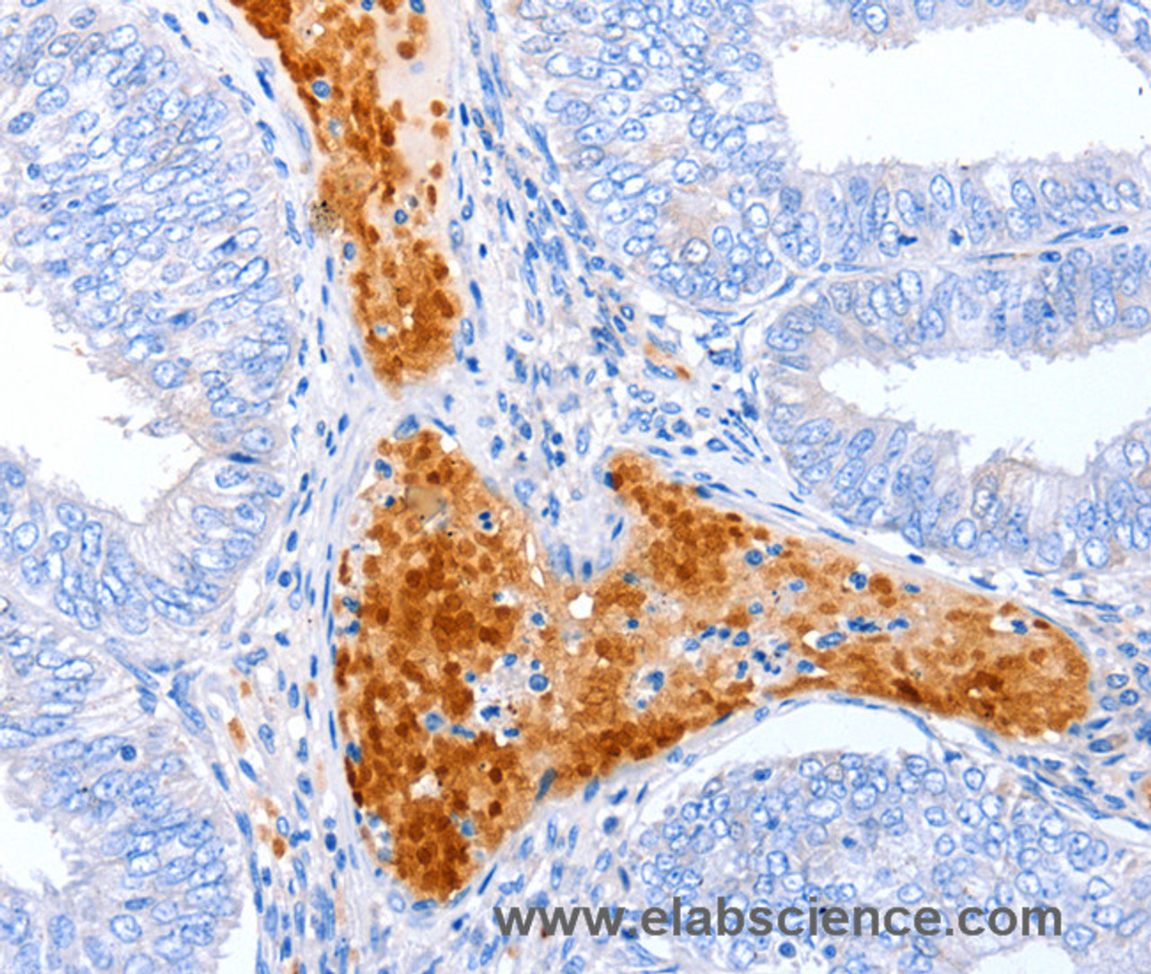 Immunohistochemistry of paraffin-embedded Human cervical cancer using ENPP7 Polyclonal Antibody at dilution of 1:50