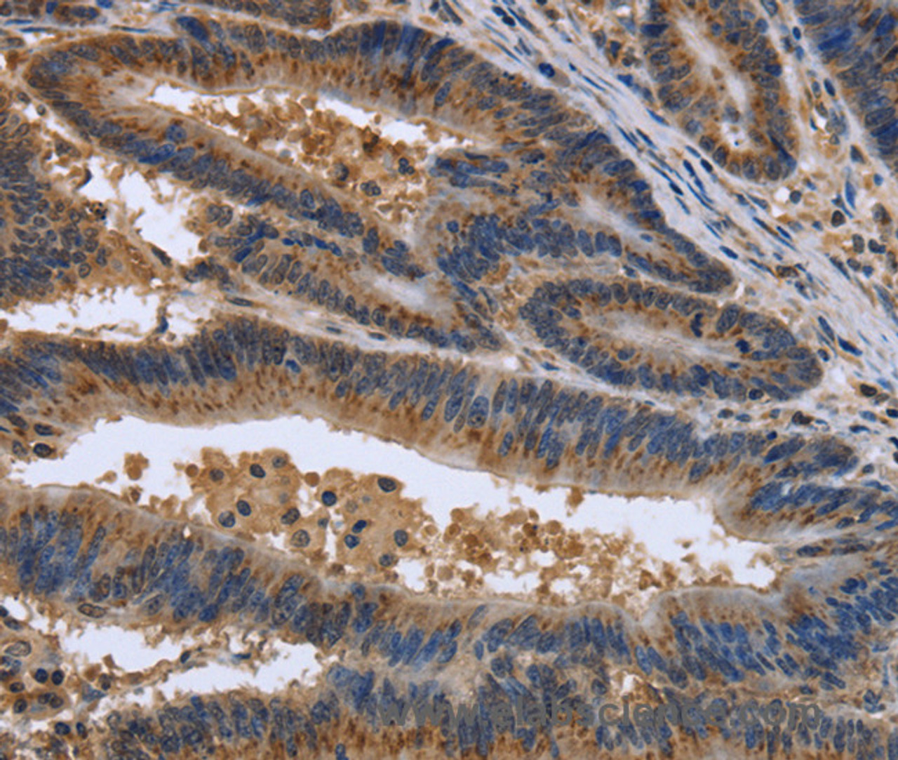 Immunohistochemistry of paraffin-embedded Human colon cancer using EPOR Polyclonal Antibody at dilution of 1:30