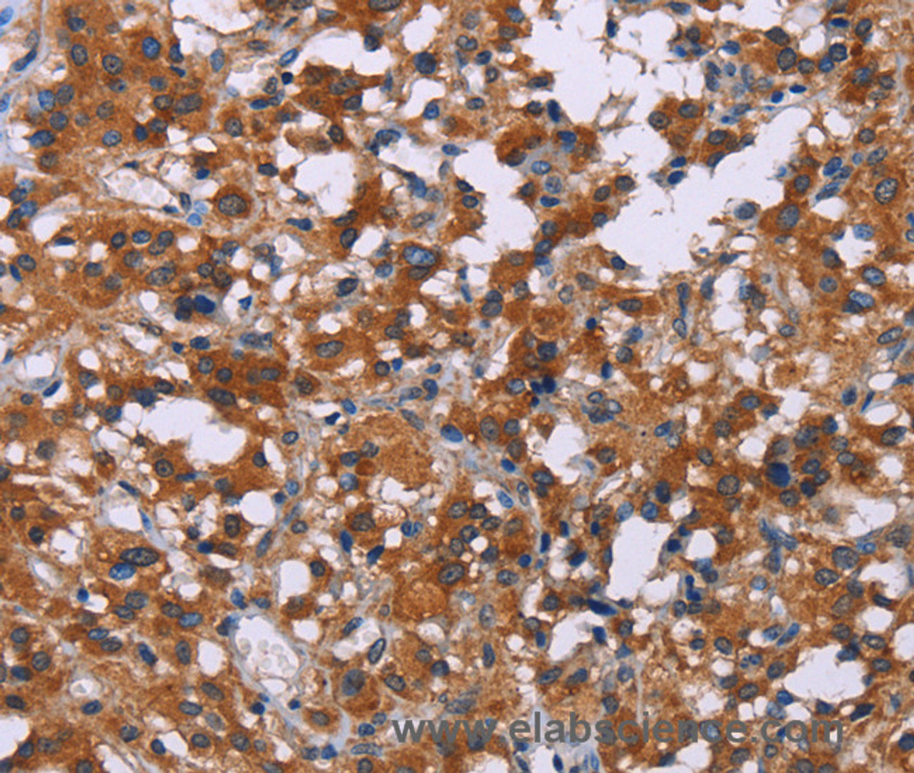 Immunohistochemistry of paraffin-embedded Human thyroid cancer using ERK1/2 Polyclonal Antibody at dilution of 1:30