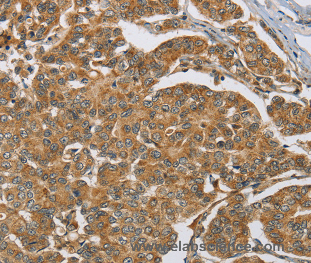 Immunohistochemistry of paraffin-embedded Human breast cancer tissue using ERK 3 Polyclonal Antibody at dilution 1:40