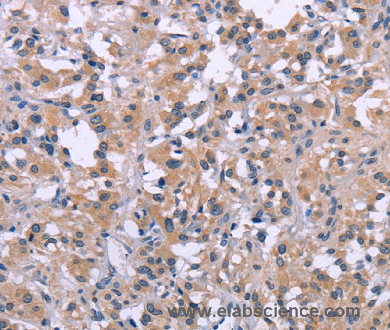 Immunohistochemistry of paraffin-embedded Human thyroid cancer using MKP-1 Polyclonal Antibody at dilution of 1:30