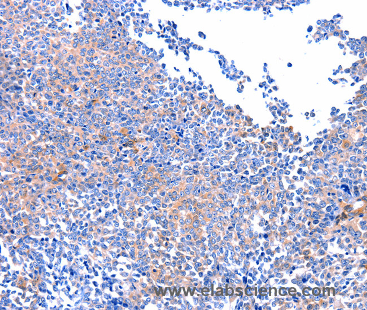 Immunohistochemistry of paraffin-embedded Human ovarian cancer using FAK Polyclonal Antibody at dilution of 1:75