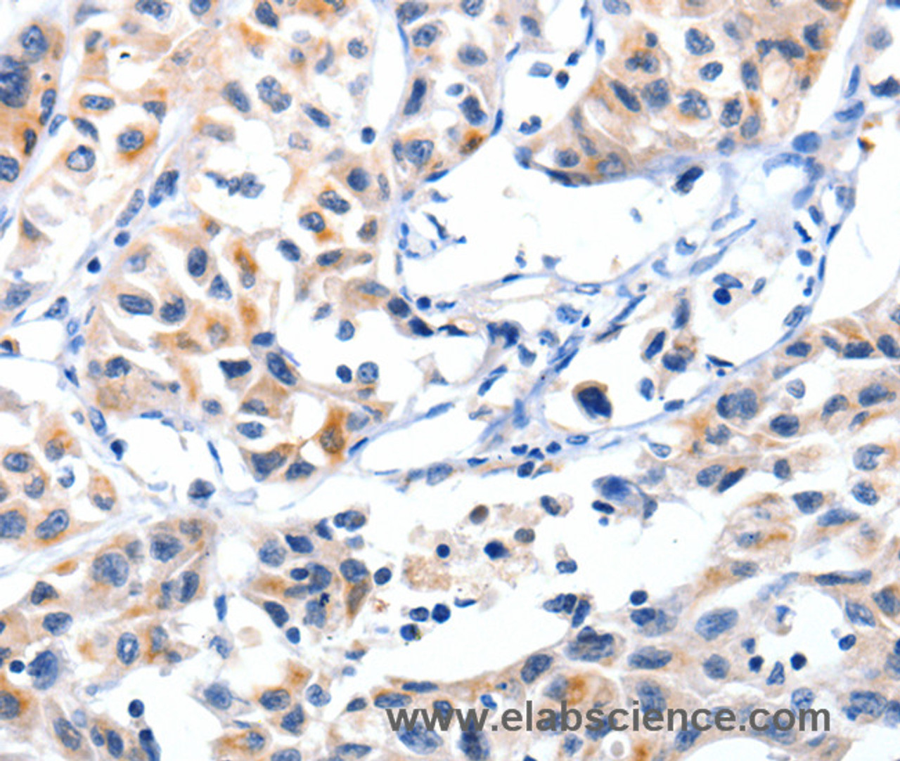 Immunohistochemistry of paraffin-embedded Human lung cancer tissue using Fibulin 5 Polyclonal Antibody at dilution 1:85