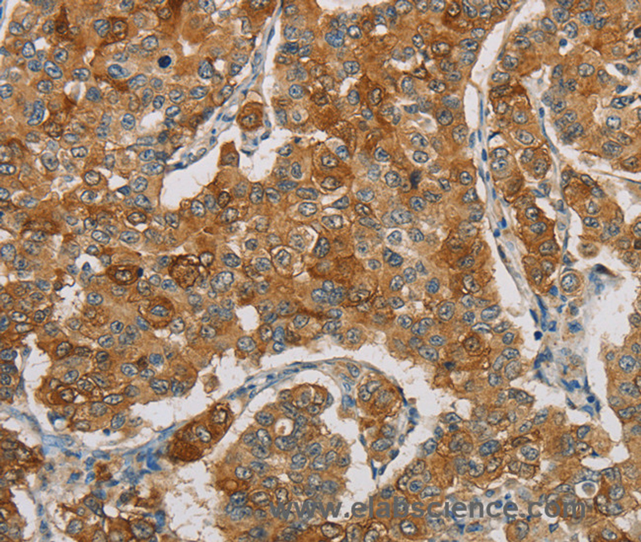 Immunohistochemistry of paraffin-embedded Human breast cancer using FOXF2 Polyclonal Antibody at dilution of 1:30