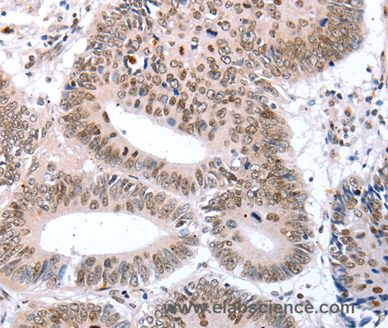 Immunohistochemistry of paraffin-embedded Human colon cancer tissue using TBX2 Polyclonal Antibody at dilution 1:32