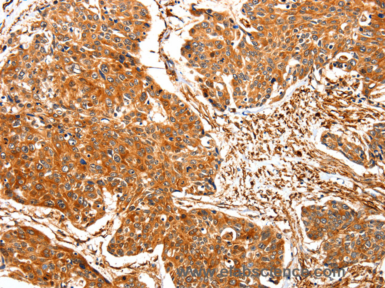 Immunohistochemistry of paraffin-embedded Human esophagus cancer using TPM2 Polyclonal Antibody at dilution of 1:30