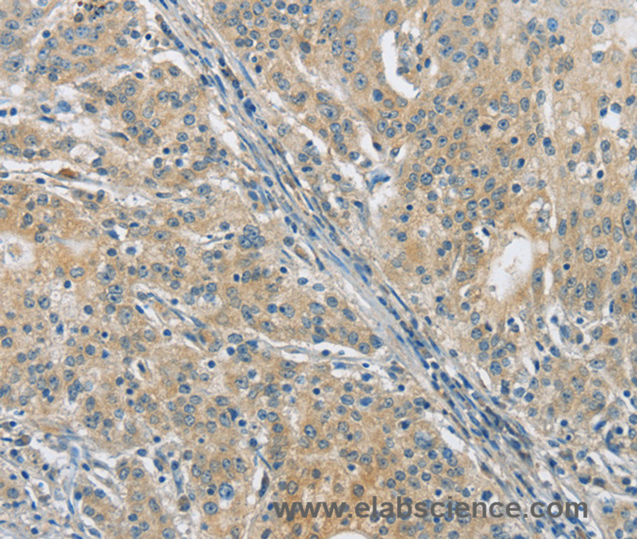 Immunohistochemistry of paraffin-embedded Human gasrtic cancer tissue using PKD1 Polyclonal Antibody at dilution 1:40