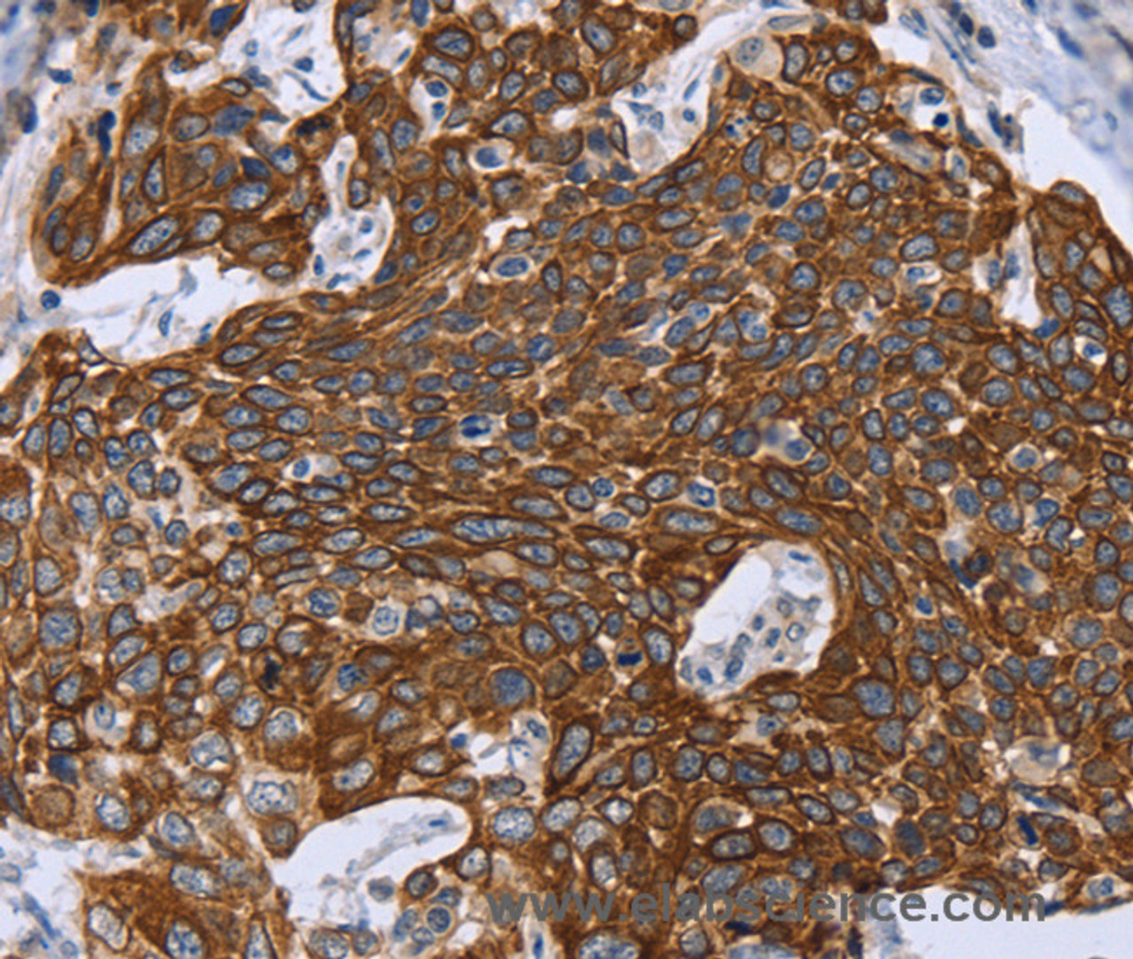 Immunohistochemistry of paraffin-embedded Human cervical cancer using GRPR Polyclonal Antibody at dilution of 1:40