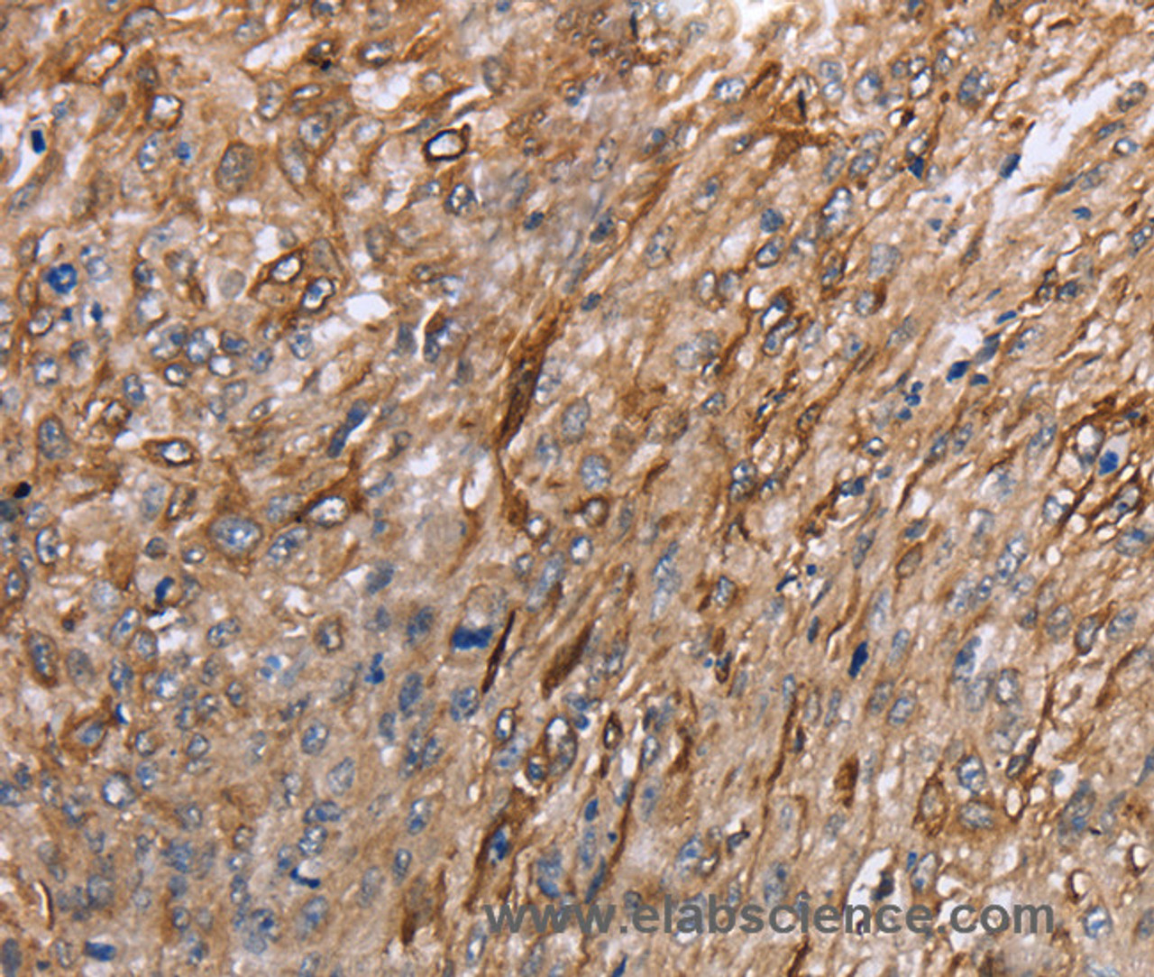 Immunohistochemistry of paraffin-embedded Human esophagus cancer using GRPR Polyclonal Antibody at dilution of 1:40