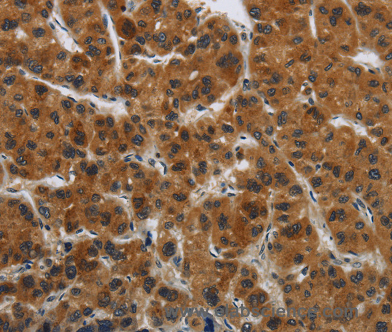 Immunohistochemistry of paraffin-embedded Human liver cancer tissue using GATA5 Polyclonal Antibody at dilution 1:50