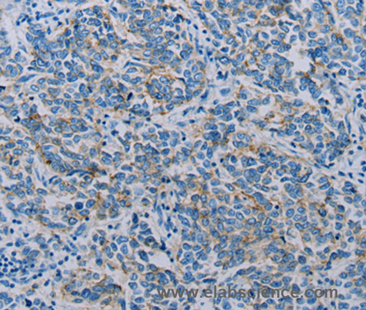 Immunohistochemistry of paraffin-embedded Human breast cancer using Claudin 4 Polyclonal Antibody at dilution of 1:35
