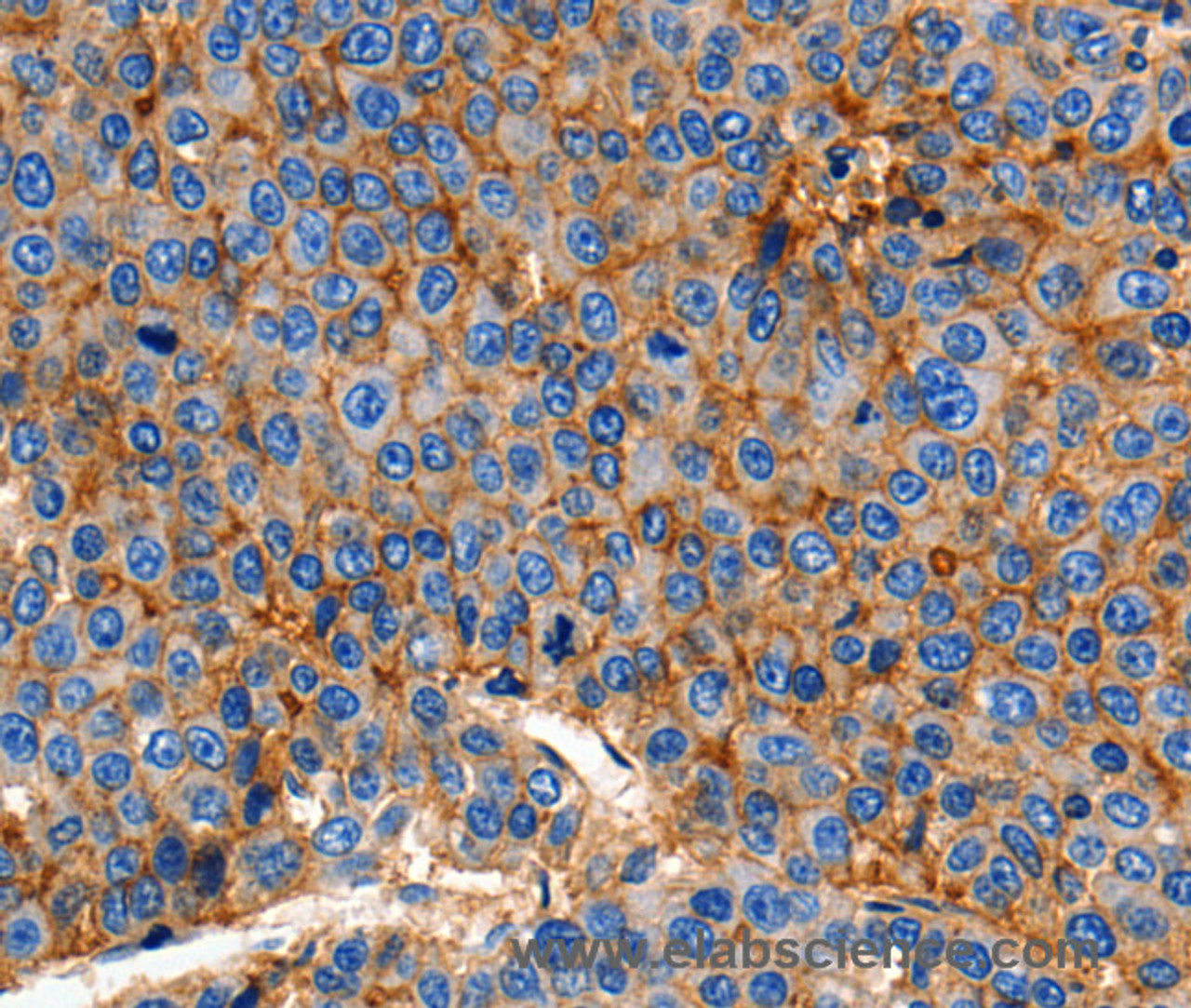 Immunohistochemistry of paraffin-embedded Human esophagus cancer using Claudin 1 Polyclonal Antibody at dilution of 1:150
